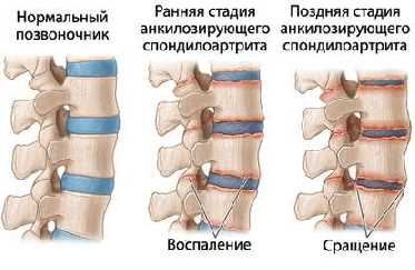 БОЛЕЗНИ СУСТАВОВ Анкилозирующий спондилоартрит, болезнь Бехтерева